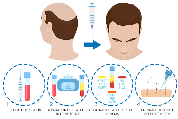 PRP platelet rich plasma hair loss treatment process