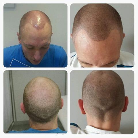 Scalp micro pigmentation before and after results