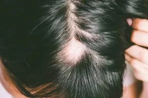 Understanding Alopecia Areata: Causes, Symptoms, and Treatments Hair Repair Clinic