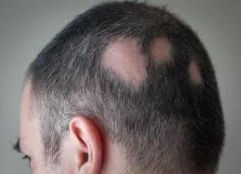 Understanding Alopecia Areata: Causes, Symptoms, and Treatments Hair Repair Clinic
