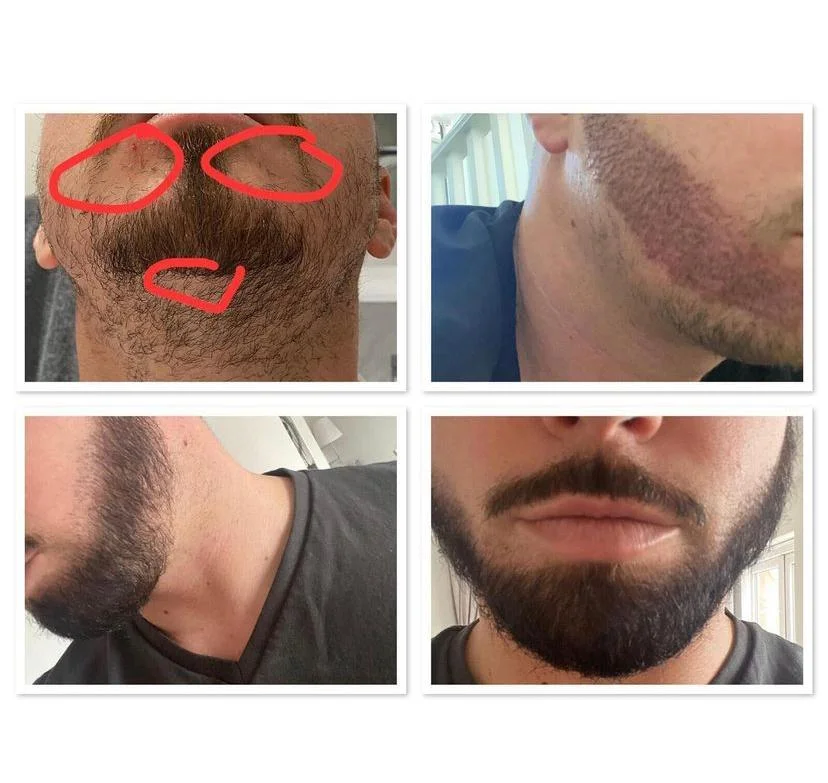 Beard transplant patient 1