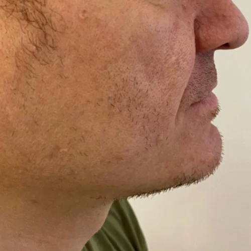 Beard transplant patient a1