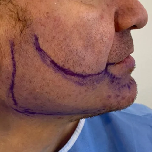 Beard transplant patient a2