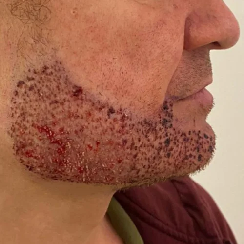 Beard transplant patient a3