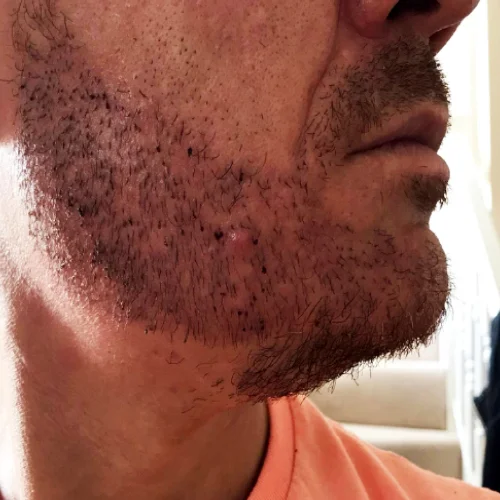 Beard transplant patient a4