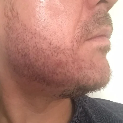 Beard transplant patient a5
