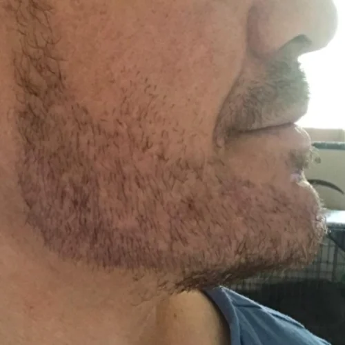 Beard transplant patient a6