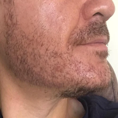 Beard transplant patient a7