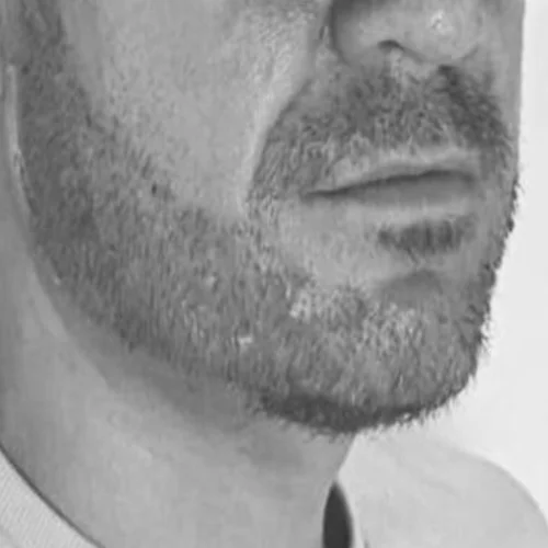 Beard transplant patient a8