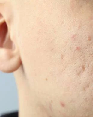 Scarring from acne or previous injuries