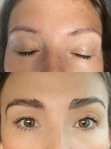 Eyebrow transplant before and after