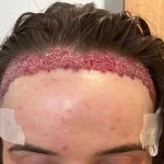 Georgia hairline after