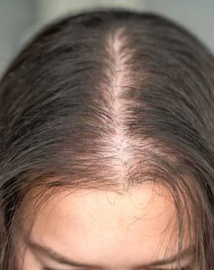 Hair loss from hormonal changes, age, stress or medical history
