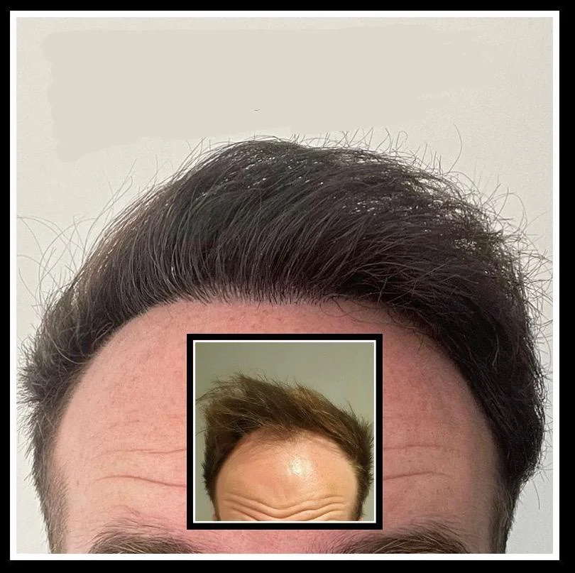 Hair transplant patient photo