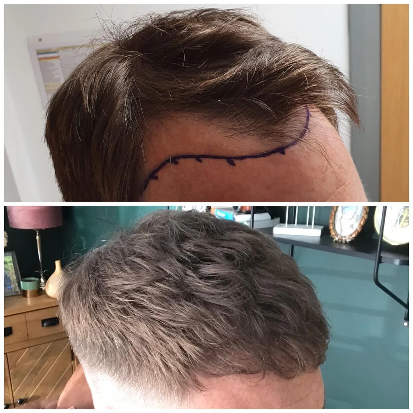 Hair transplant patient photo