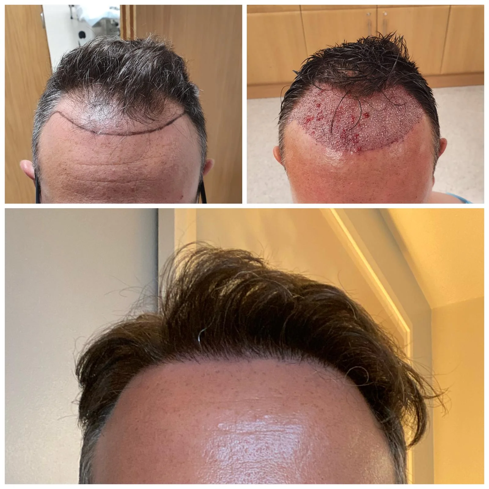 Hair transplant patient photo