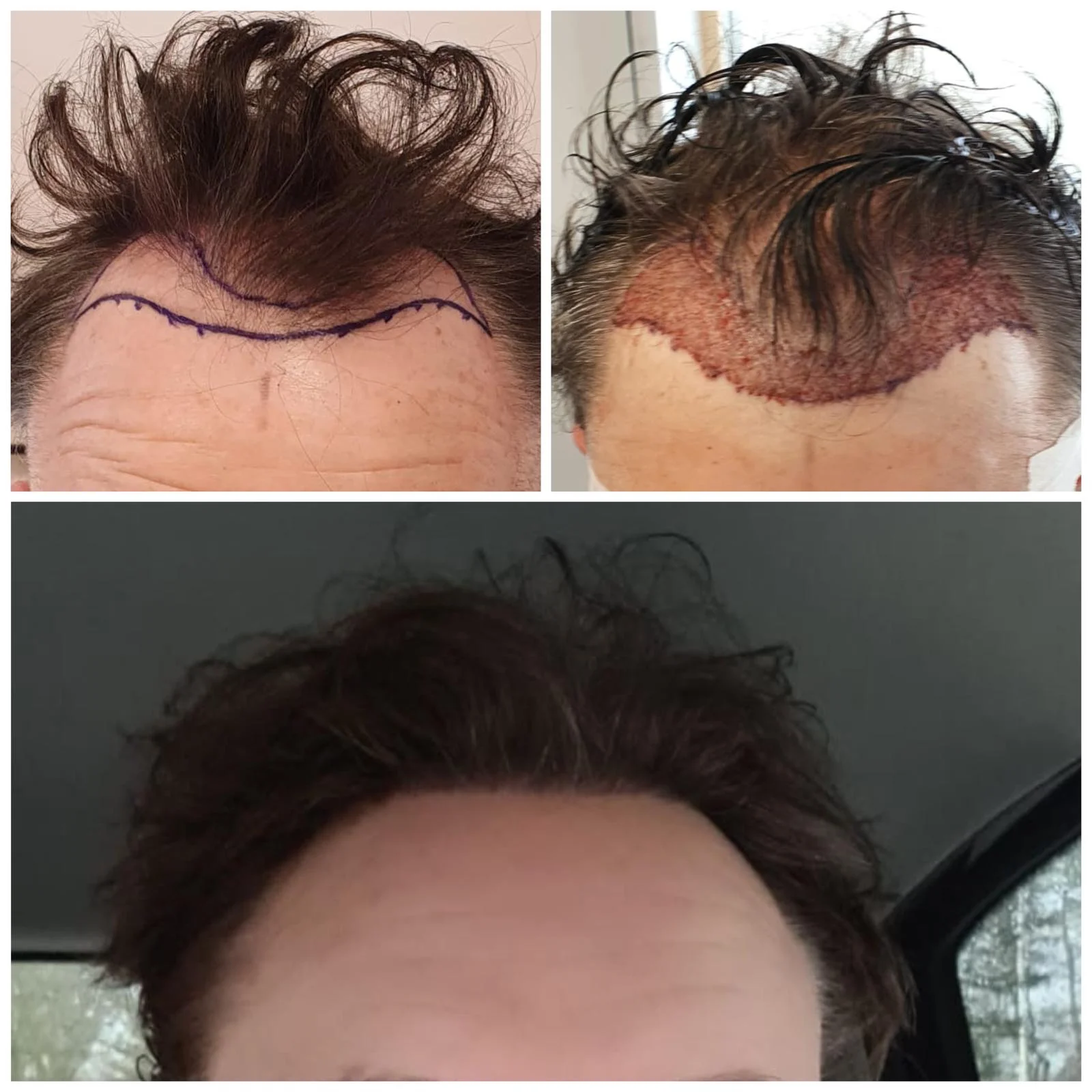 Hair transplant patient photo