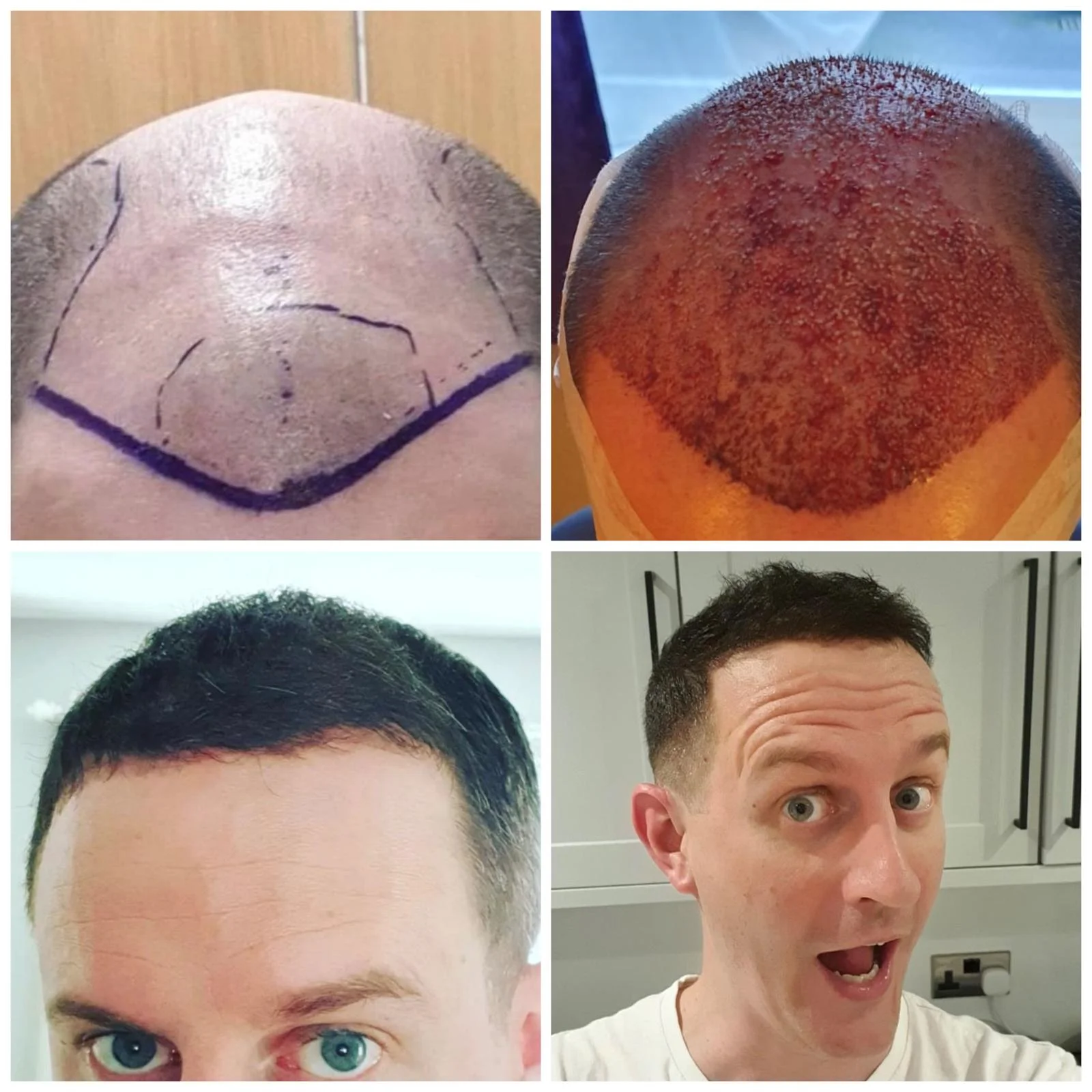 Hair transplant patient photo