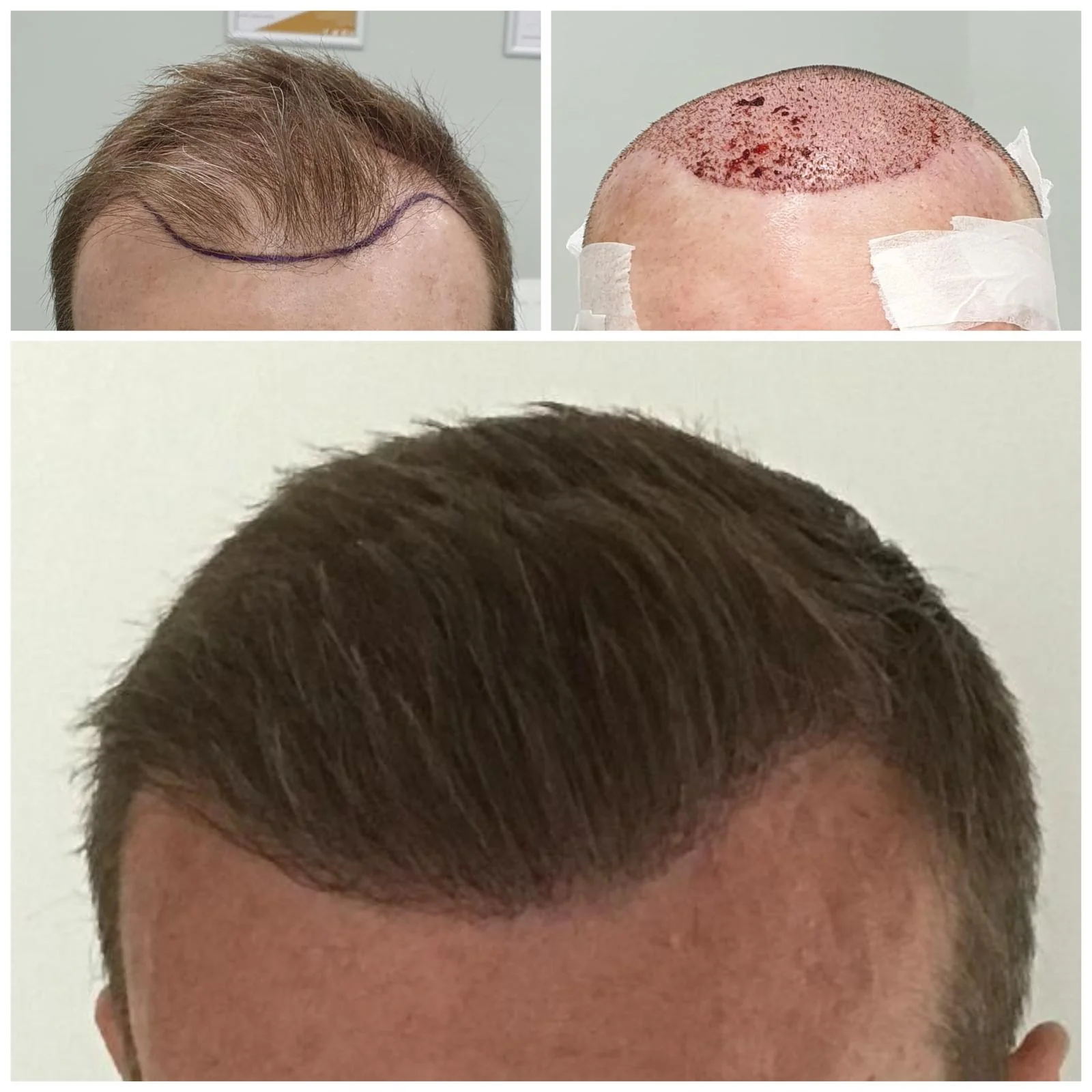 Hair transplant patient photo