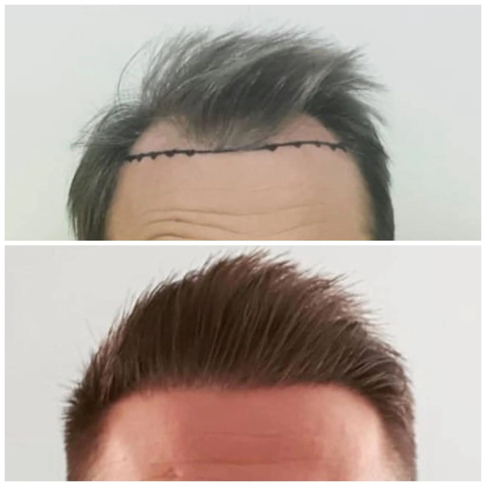 Hair transplant patient photo