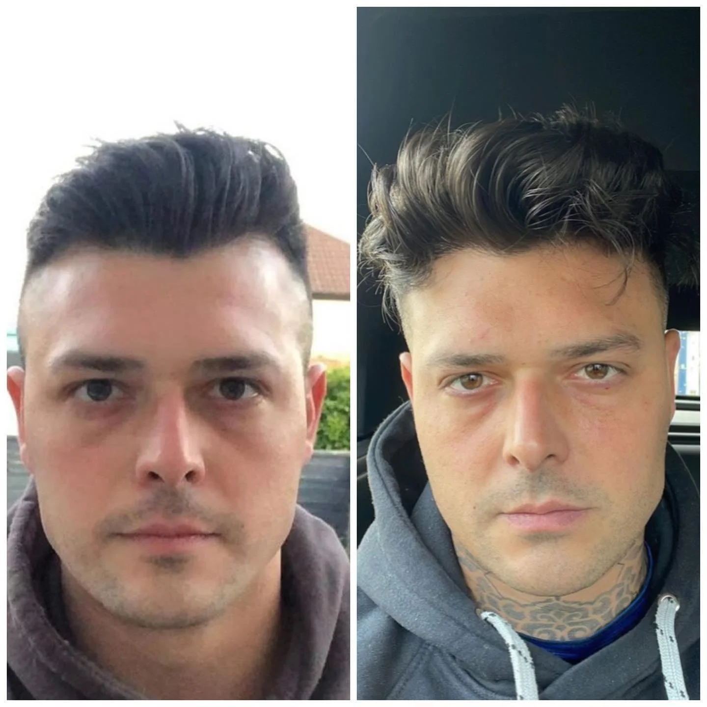 Hair transplant patient photo