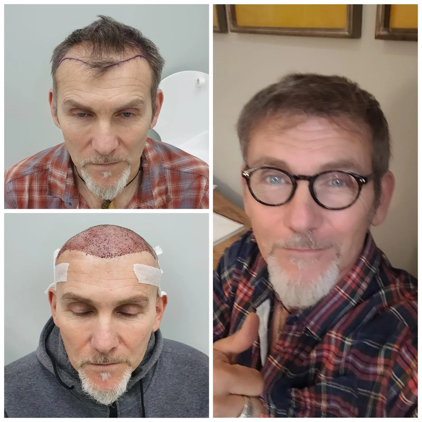 Hair transplant patient photo