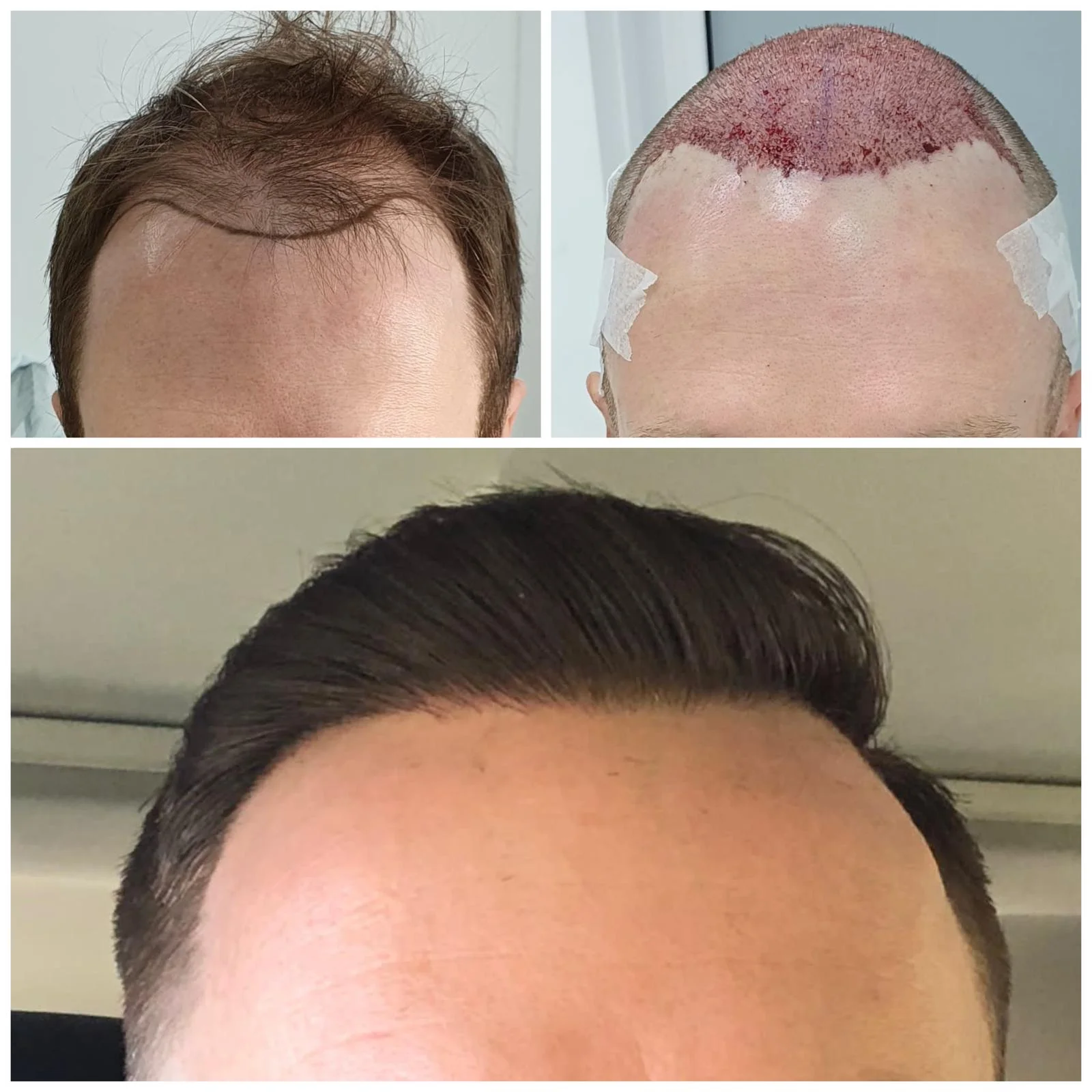 Hair transplant patient photo