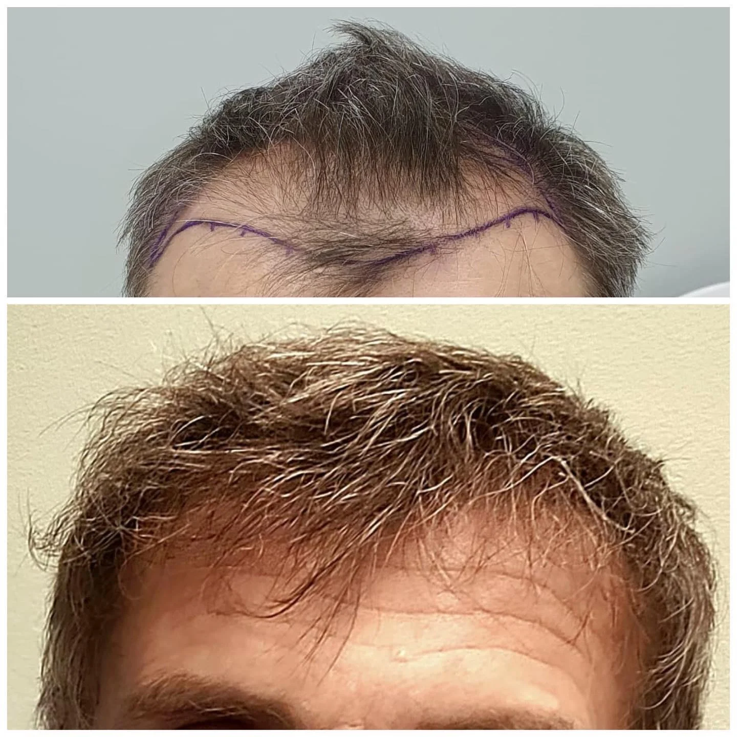 Hair transplant patient photo