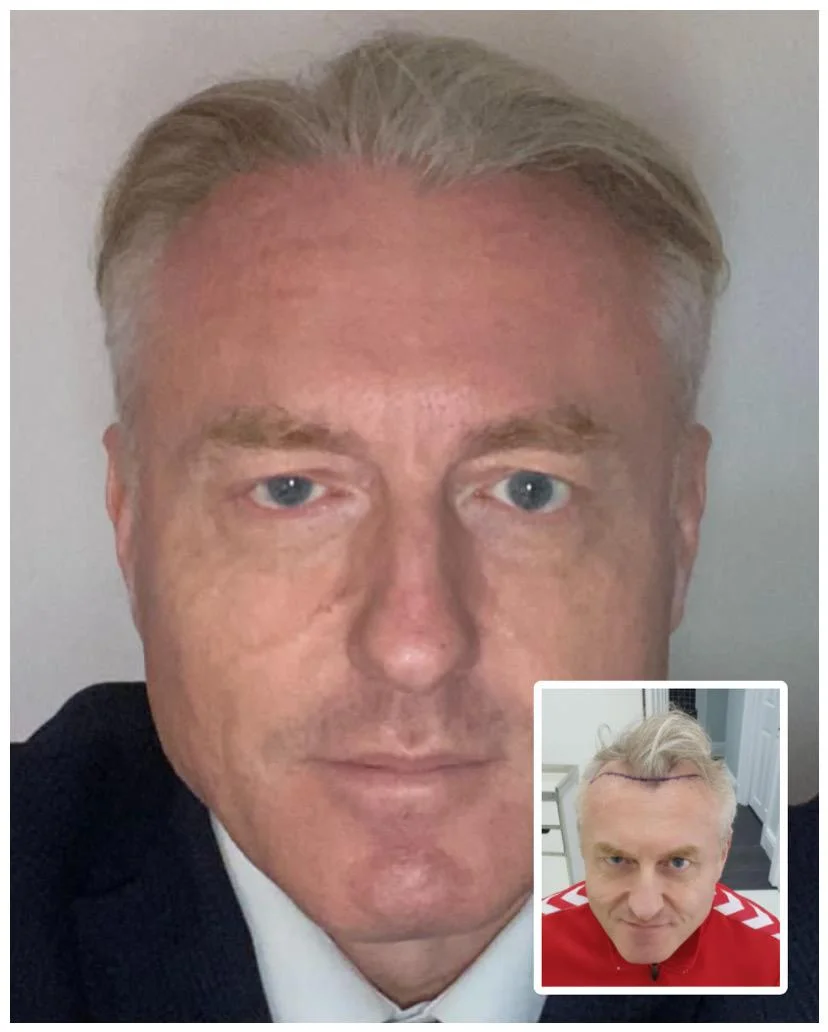 Hair transplant patient photo