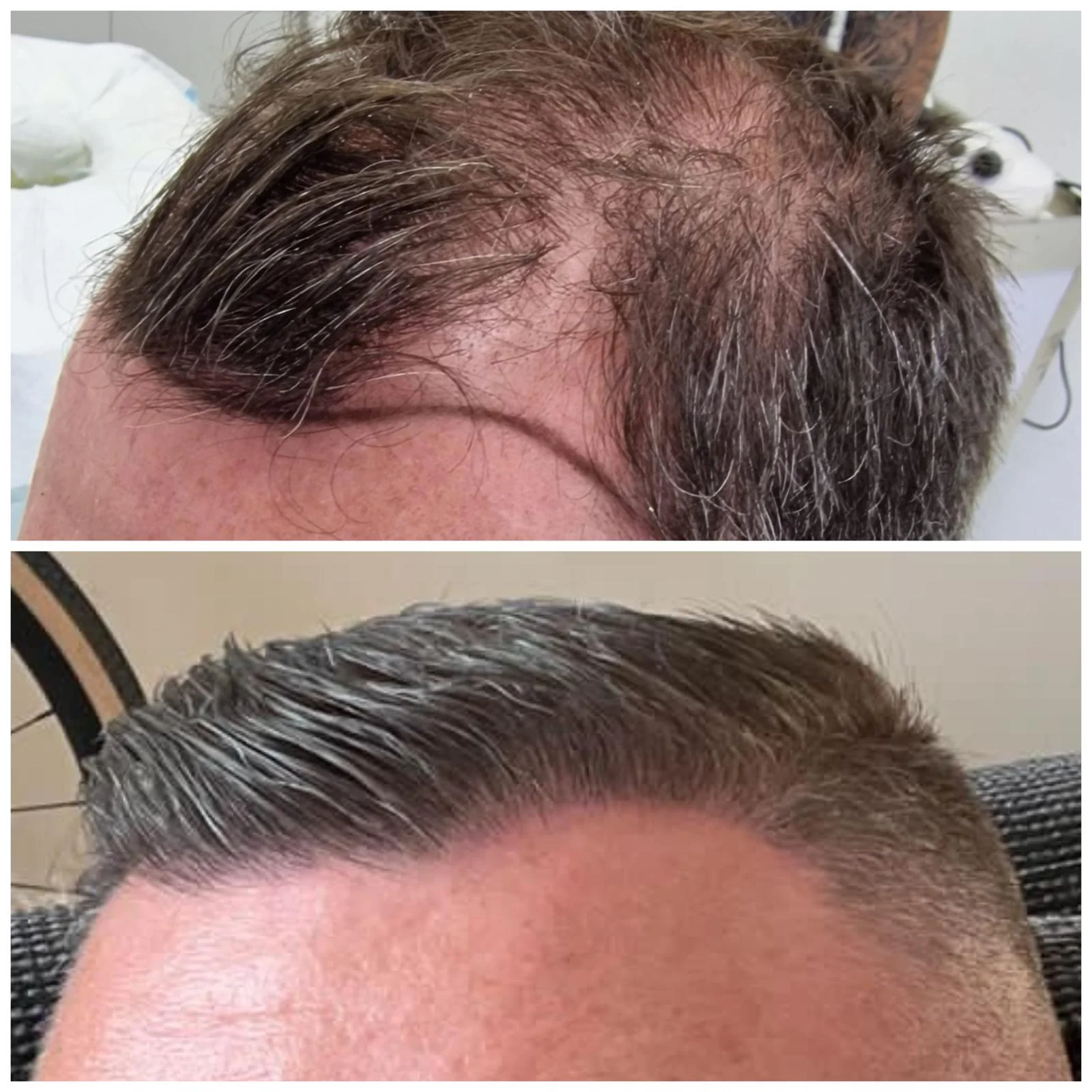 Hair transplant patient photo