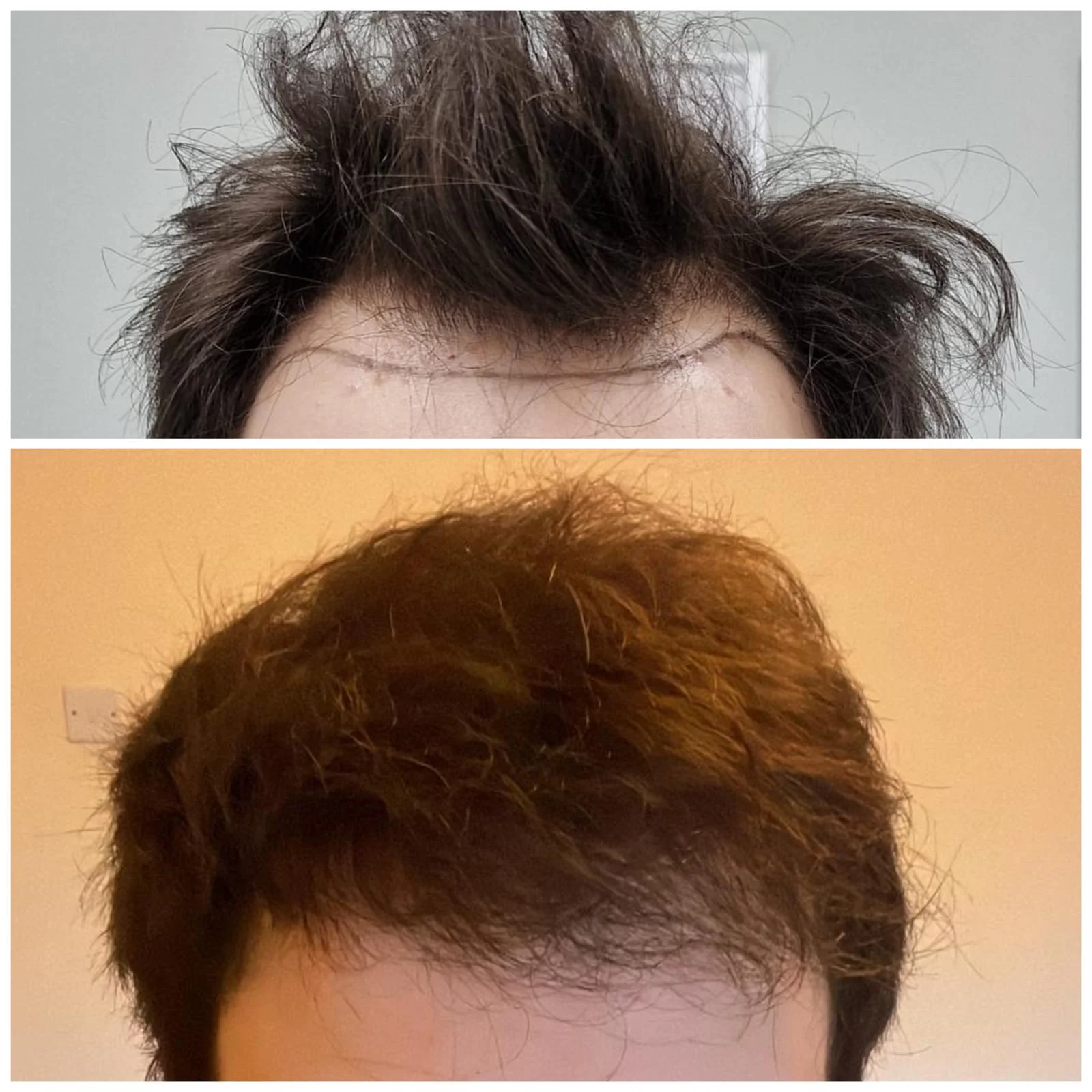 Hair transplant patient photo