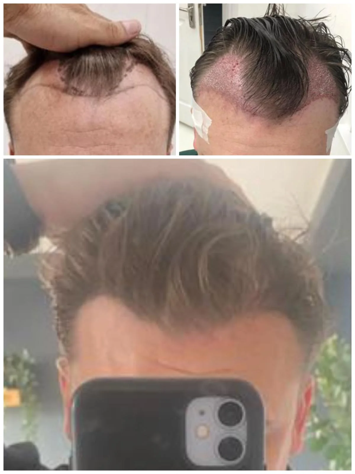 Hair transplant patient photo