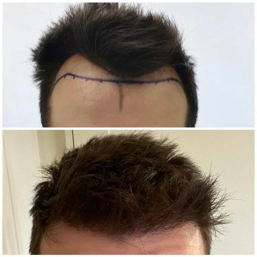 Hair transplant patient photo