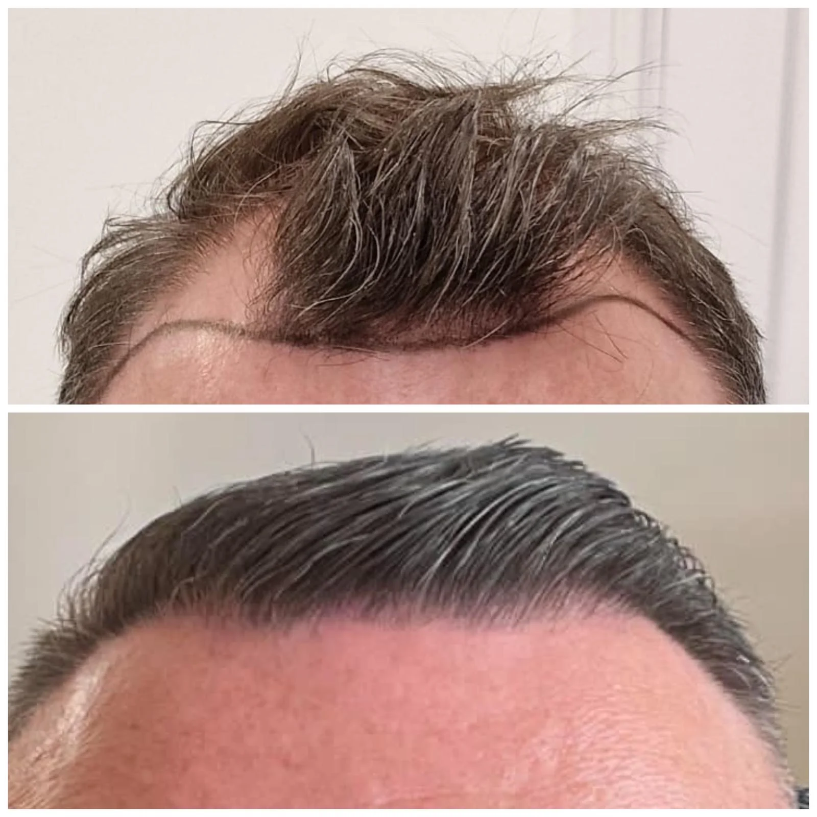 Hair transplant patient photo