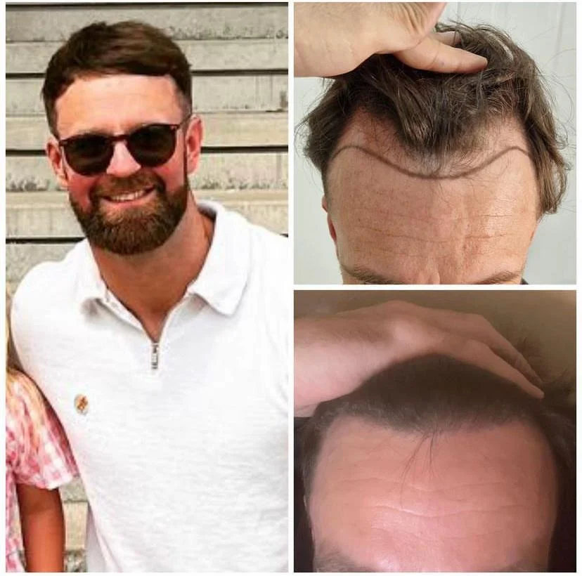 Hair transplant patient photo