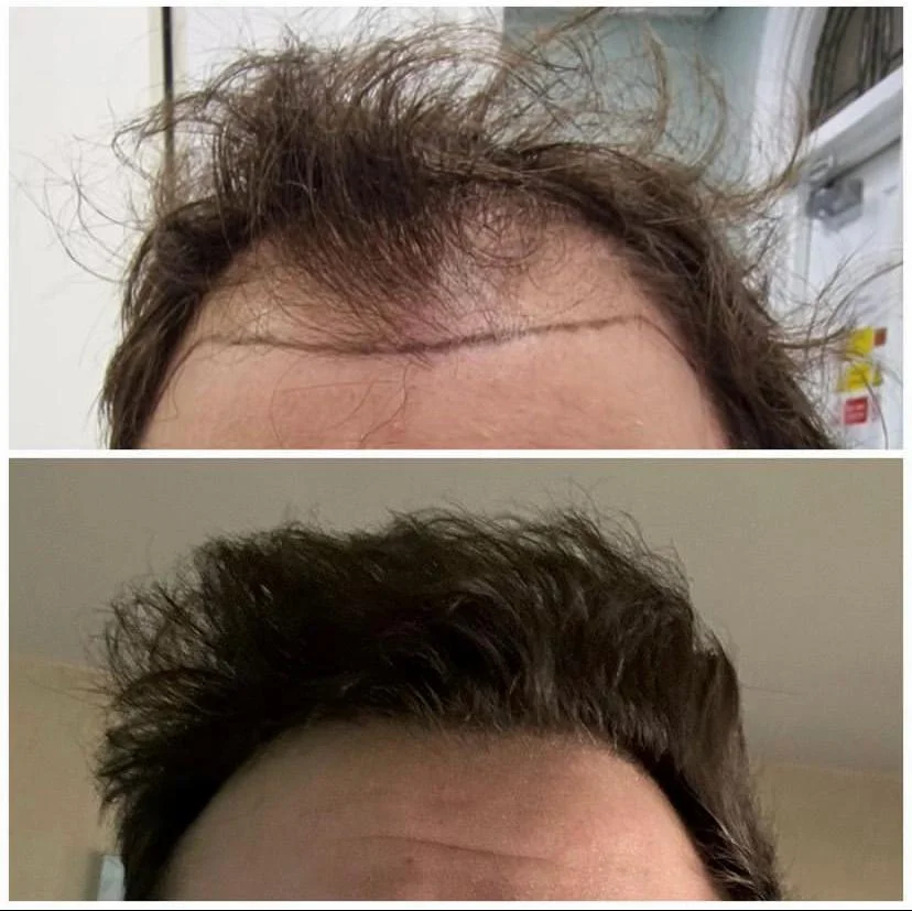 Hair transplant patient photo