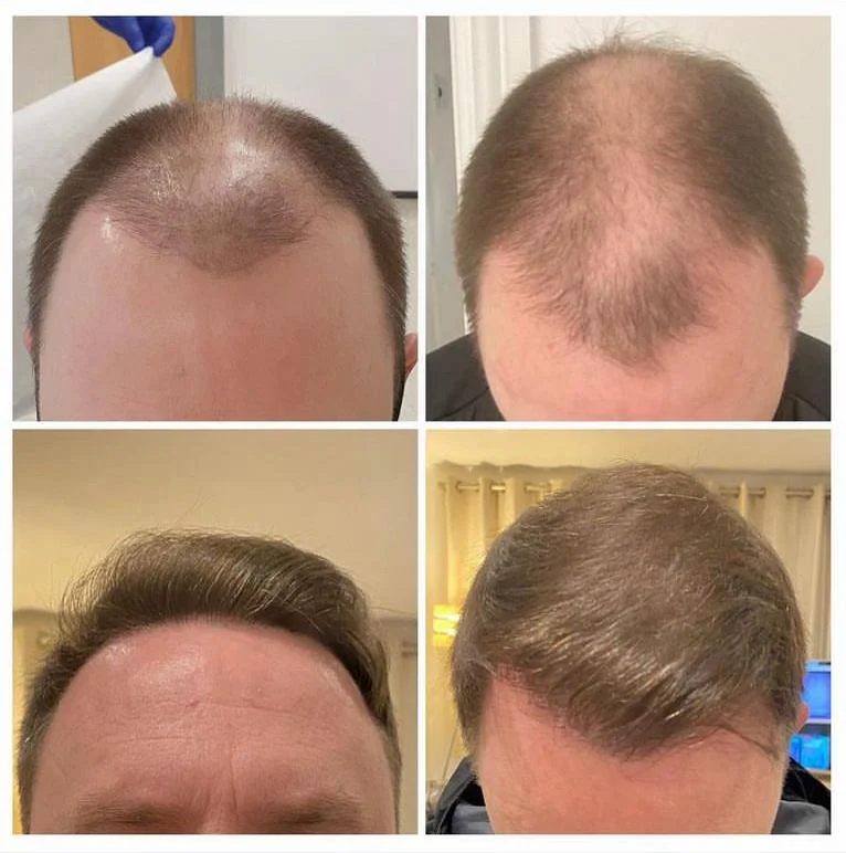 Hair transplant patient photo