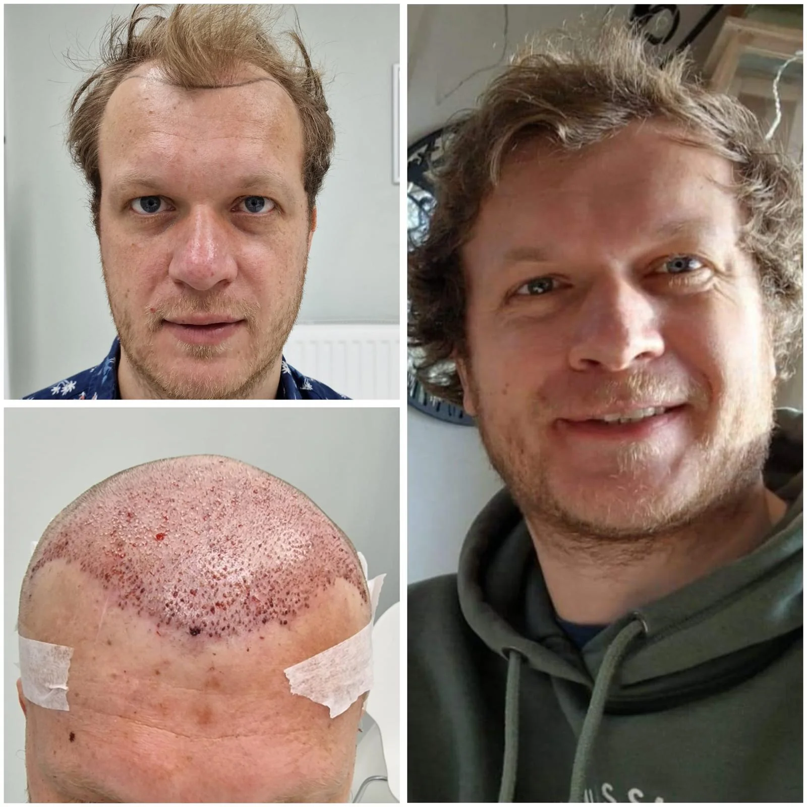 Hair transplant patient photo