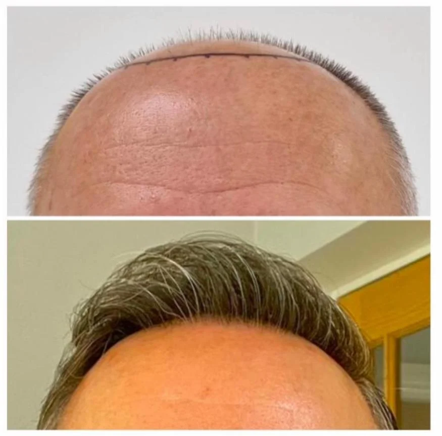 Hair transplant patient photo