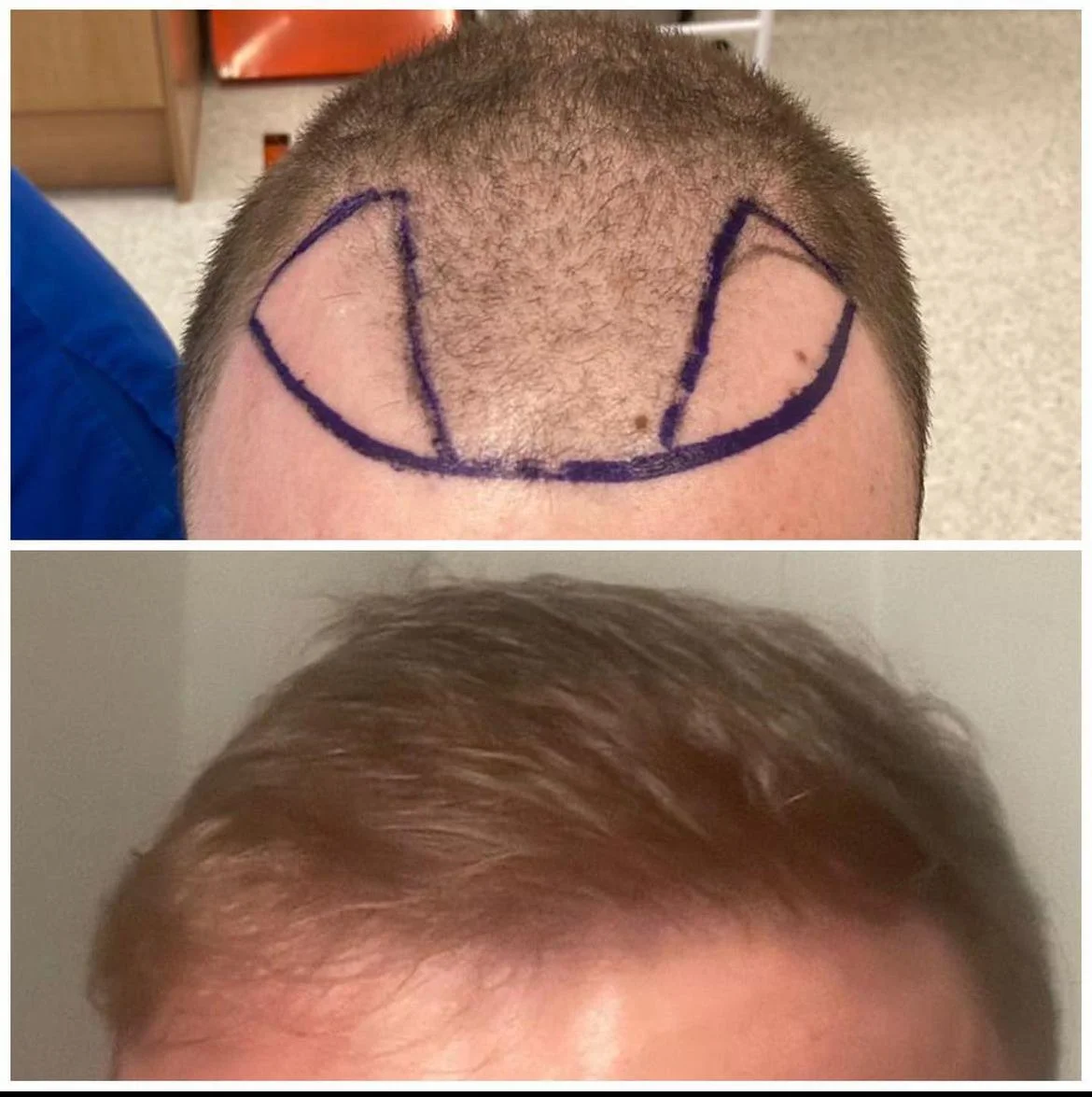 Hair transplant patient photo