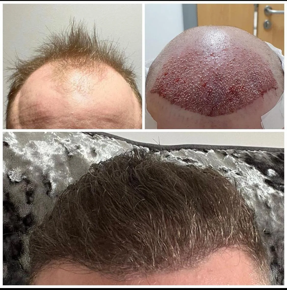 Hair transplant patient photo