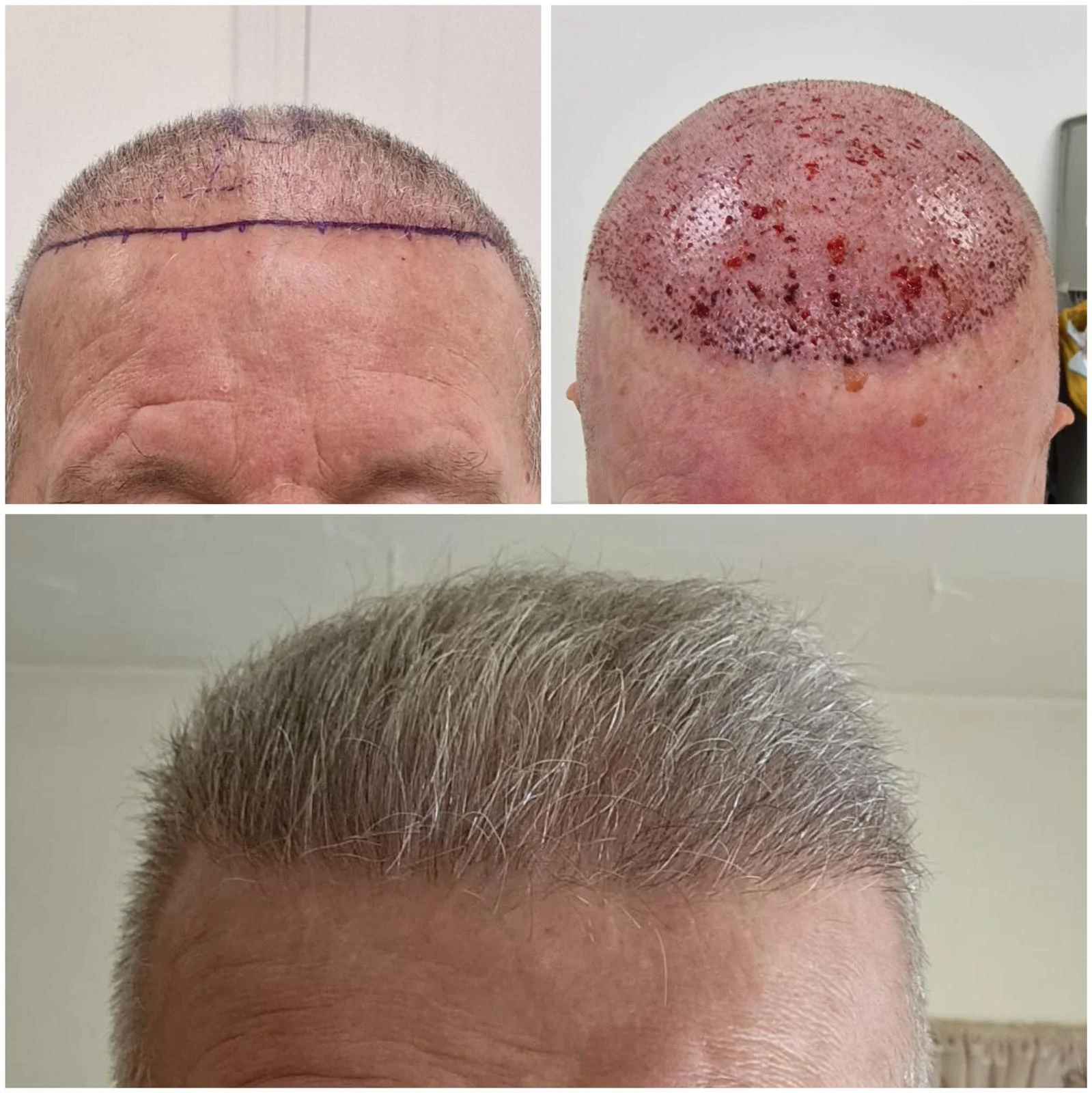 Hair transplant patient photo