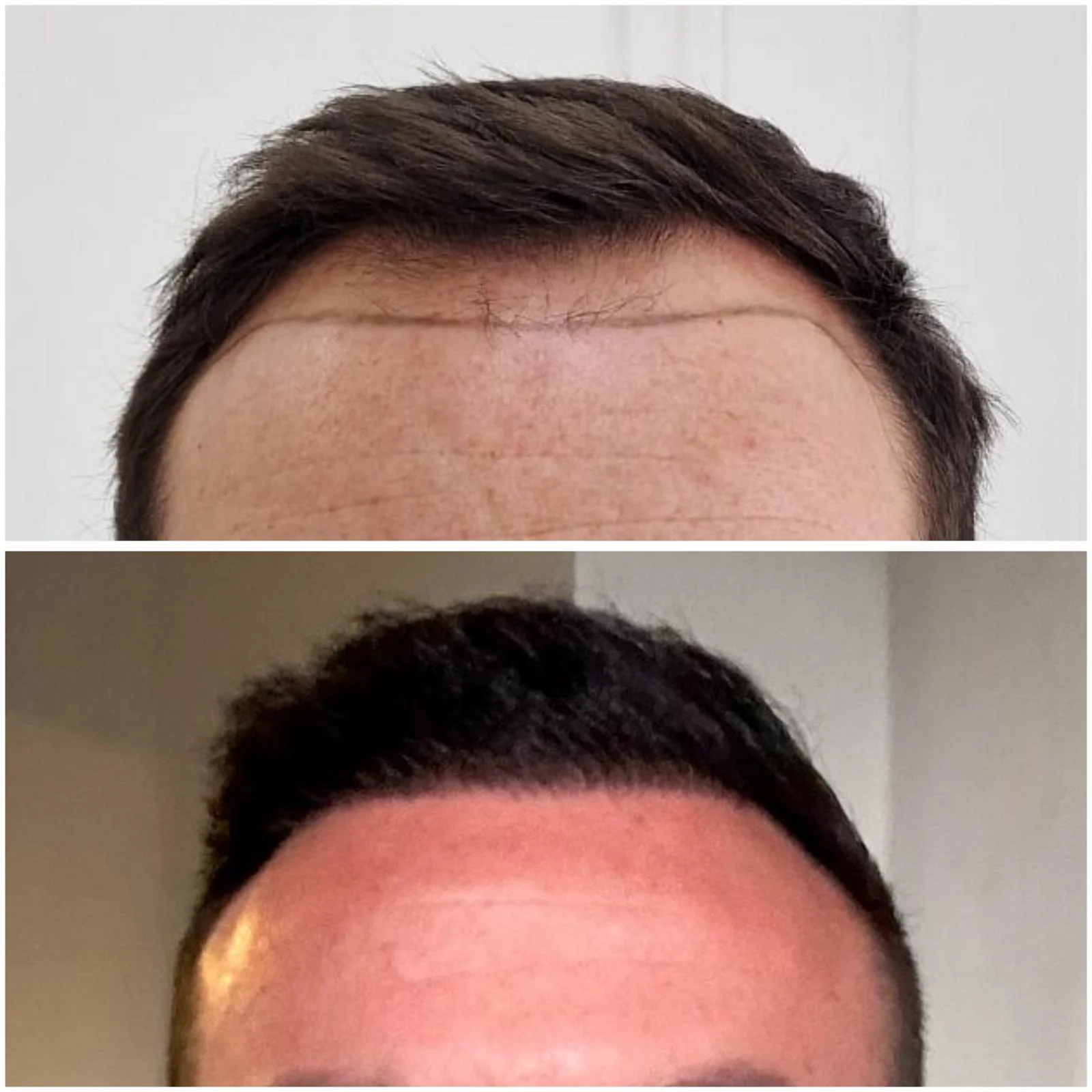 Hair transplant patient photo