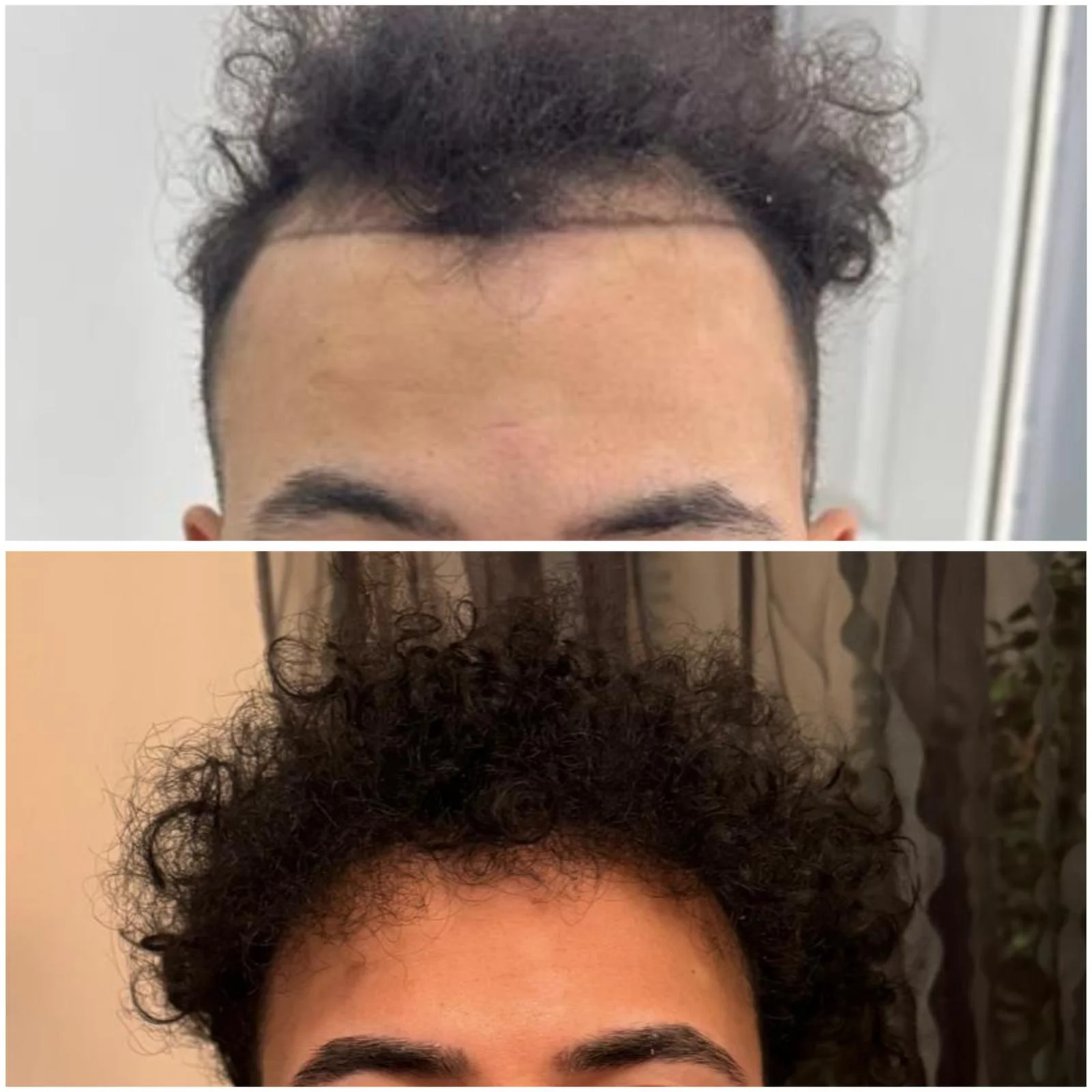 Hair transplant patient photo