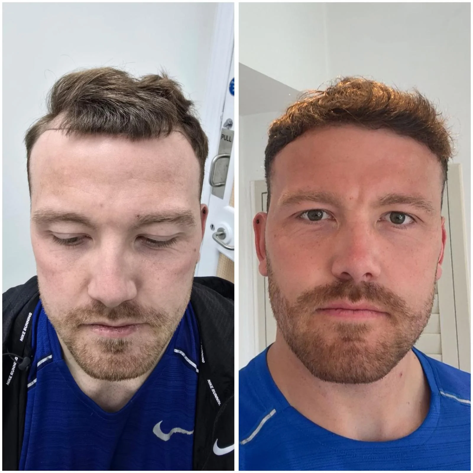 Hair transplant patient photo