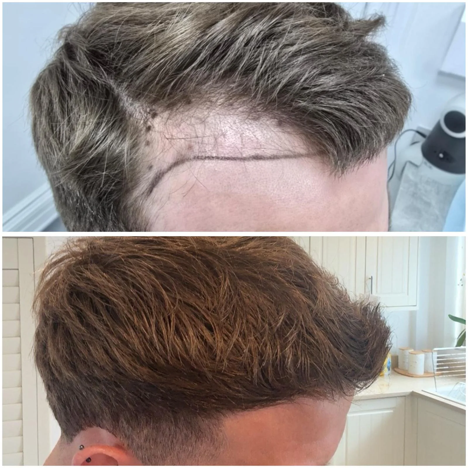 Hair transplant patient photo