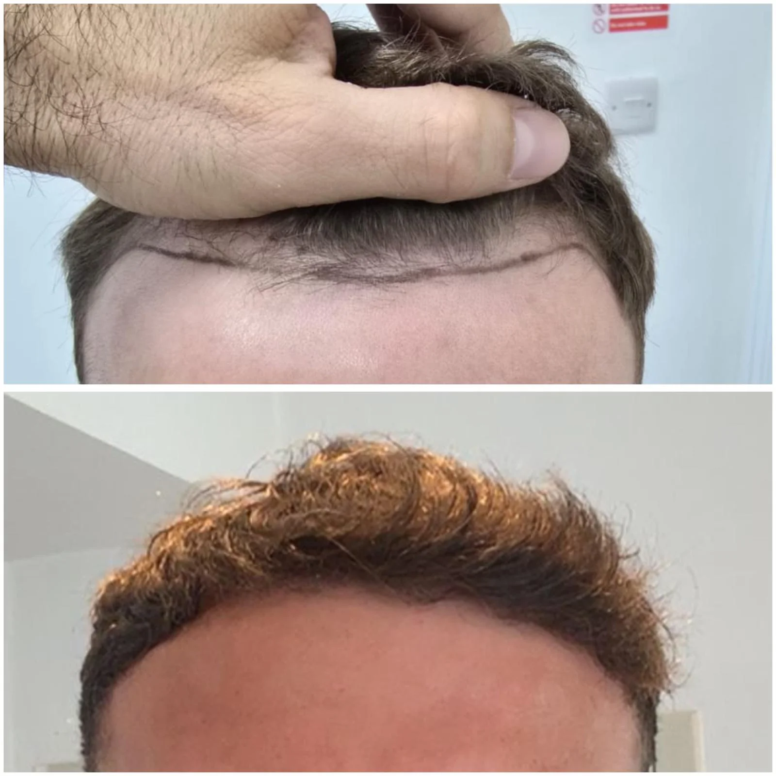 Hair transplant patient photo