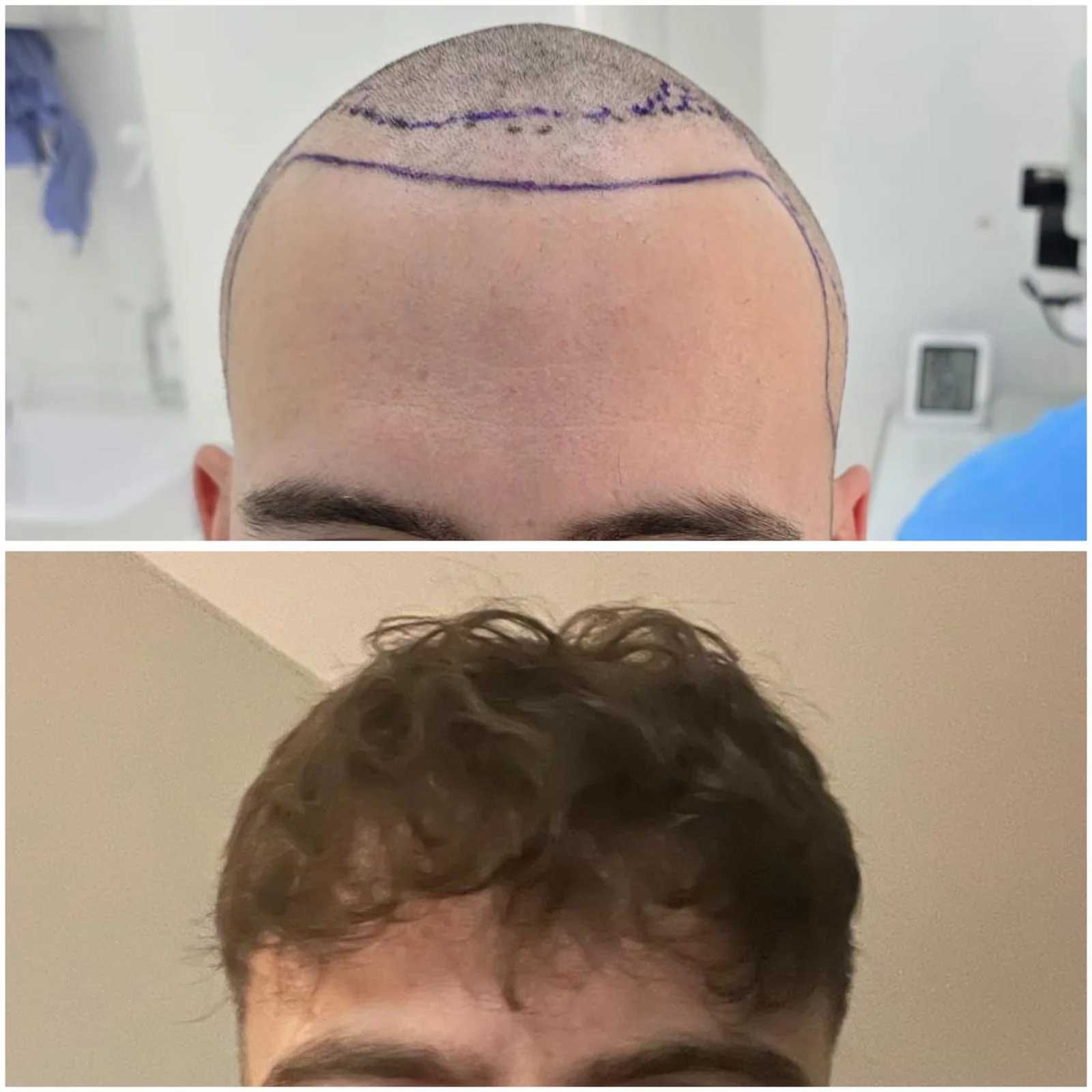 Hair transplant patient photo