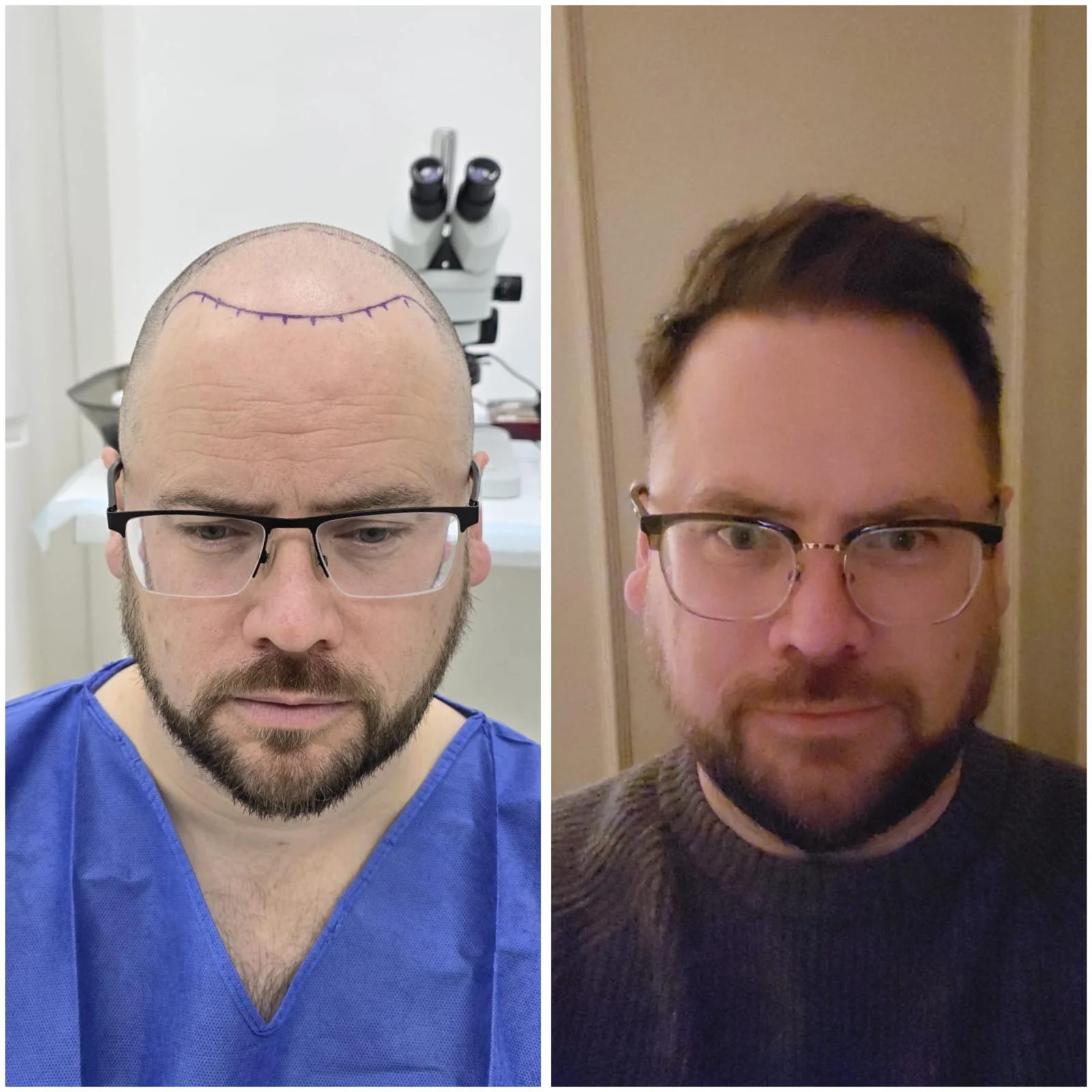 Hair transplant patient photo