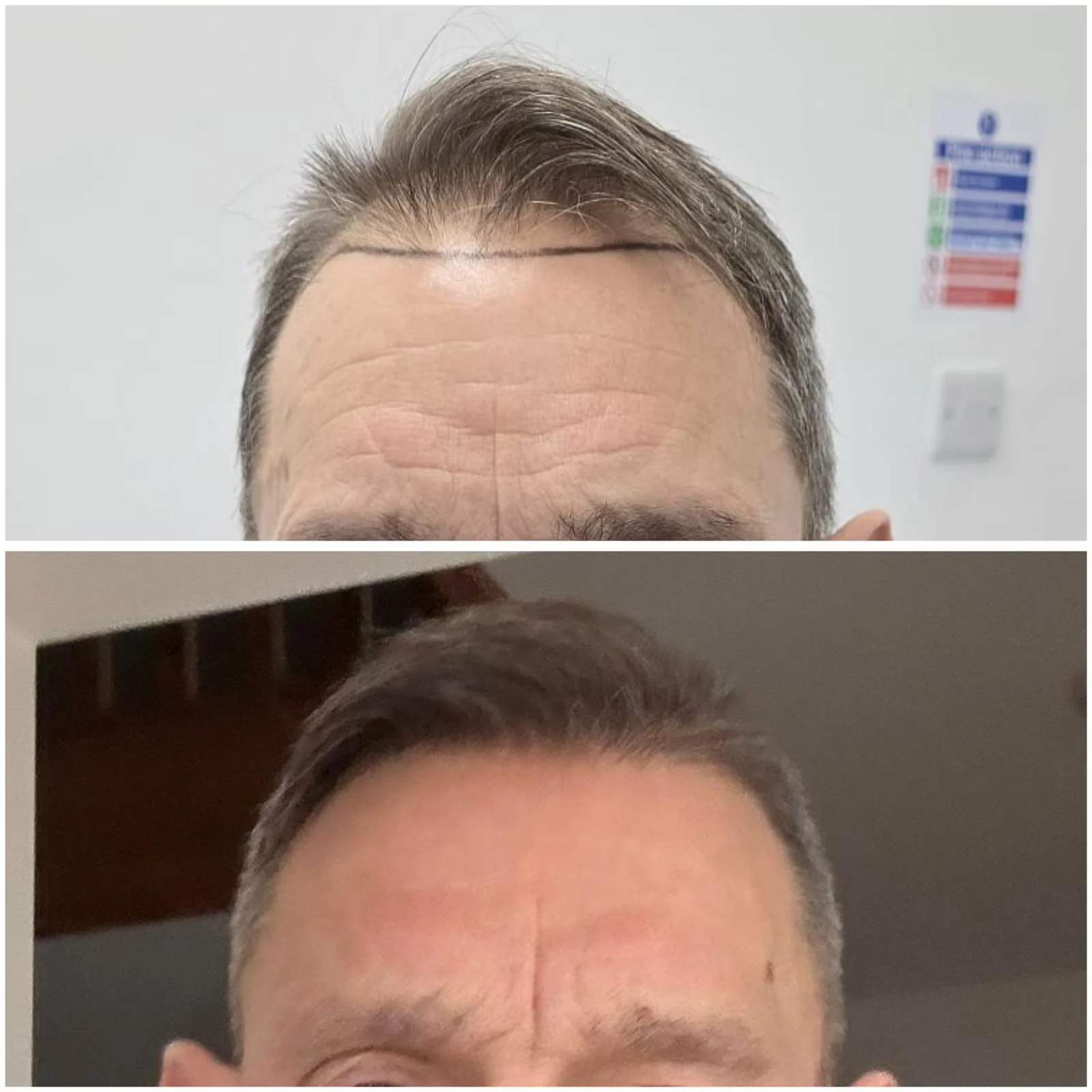 Hair transplant patient photo